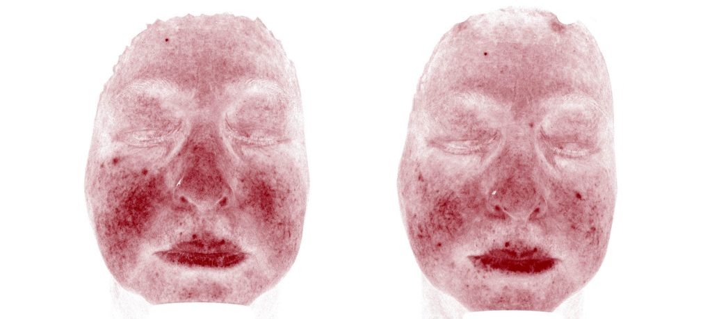 redness before after 01